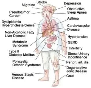 Diseases-related-to-obesity-300x